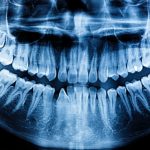 CBCT and Panoramic X-ray Machines: Why Dental Clinics May Need Both